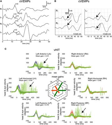 Hierarchical Cluster Analysis of Semicircular Canal and Otolith Deficits in Bilateral Vestibulopathy